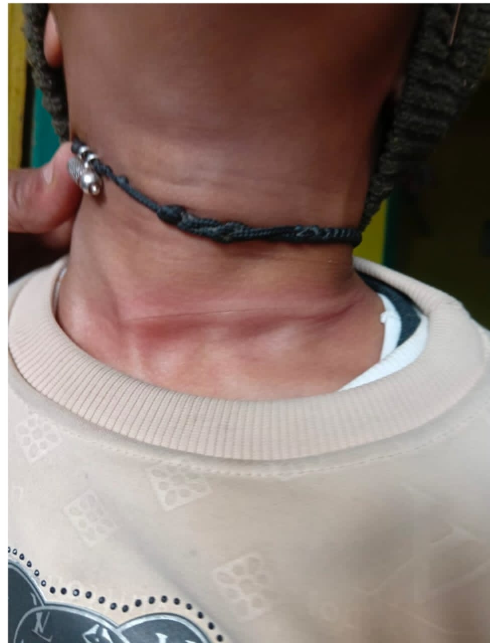 जानलेवा चाइनीज माजा बना खतरा स्कूल से आरहे मासूम के गले में लगा लंबा कट,प्रतिबंध के बावजूद खुलेआम उपयोग हो रहा।